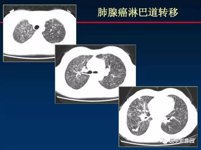 【PPT】血行播散性肺结核的影像诊断与鉴别