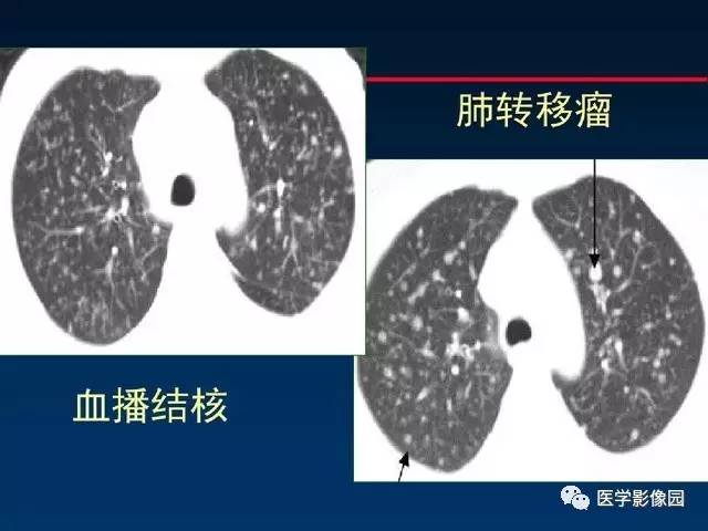 【PPT】血行播散性肺结核的影像诊断与鉴别