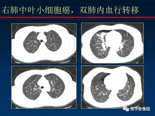 【PPT】血行播散性肺结核的影像诊断与鉴别