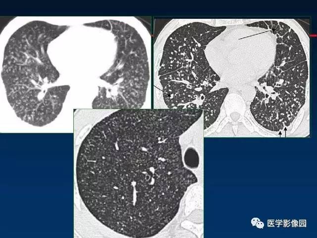 【PPT】血行播散性肺结核的影像诊断与鉴别