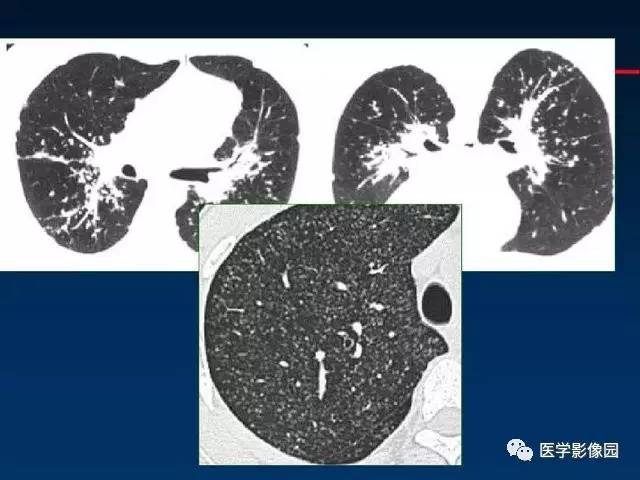 【PPT】血行播散性肺结核的影像诊断与鉴别
