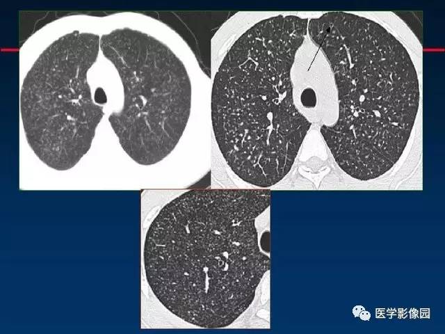 【PPT】血行播散性肺结核的影像诊断与鉴别