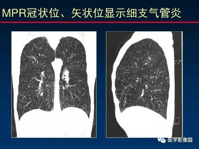 【PPT】血行播散性肺结核的影像诊断与鉴别