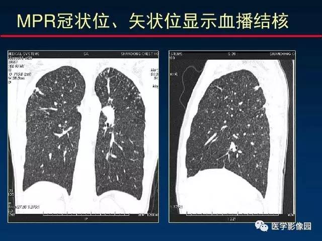 【PPT】血行播散性肺结核的影像诊断与鉴别