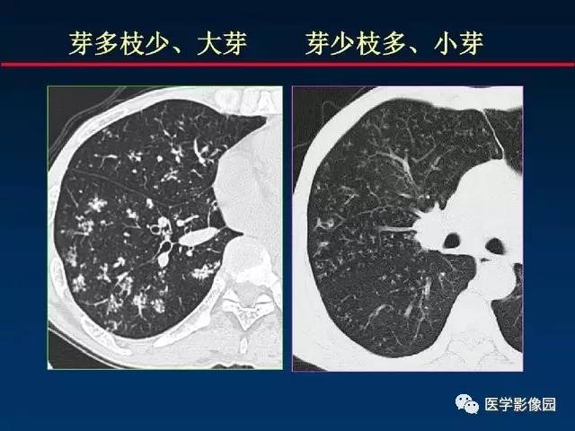【PPT】血行播散性肺结核的影像诊断与鉴别