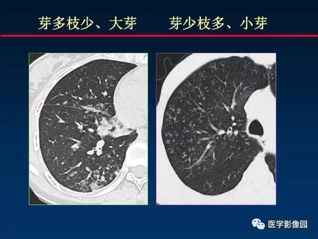 【PPT】血行播散性肺结核的影像诊断与鉴别