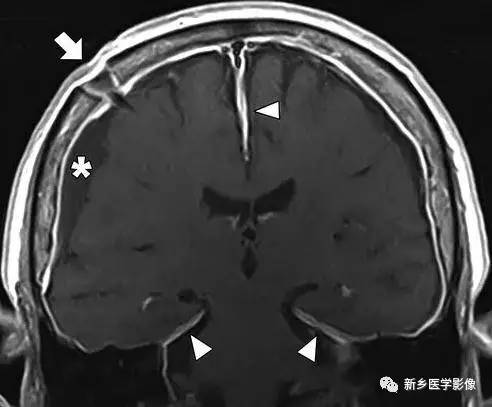 引起硬脑膜强化的7类疾病 引起硬脑膜强化的7类疾病
