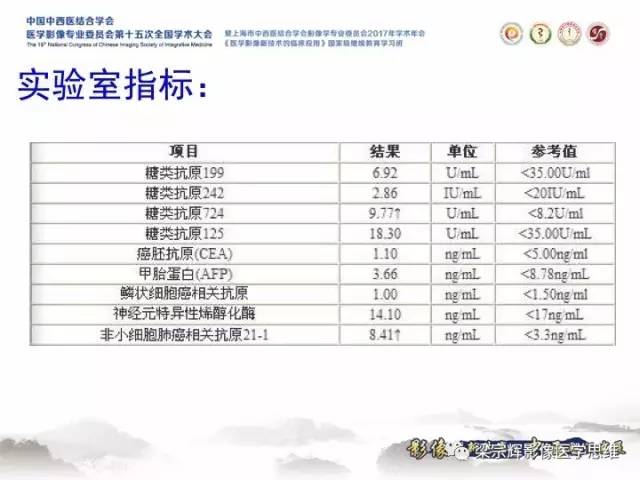 【病例】胸膜孤立性纤维瘤1例CT及MR影像表现