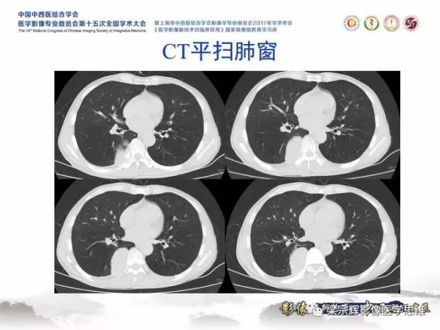 【病例】胸膜孤立性纤维瘤1例CT及MR影像表现