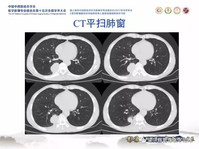 【病例】胸膜孤立性纤维瘤1例CT及MR影像表现
