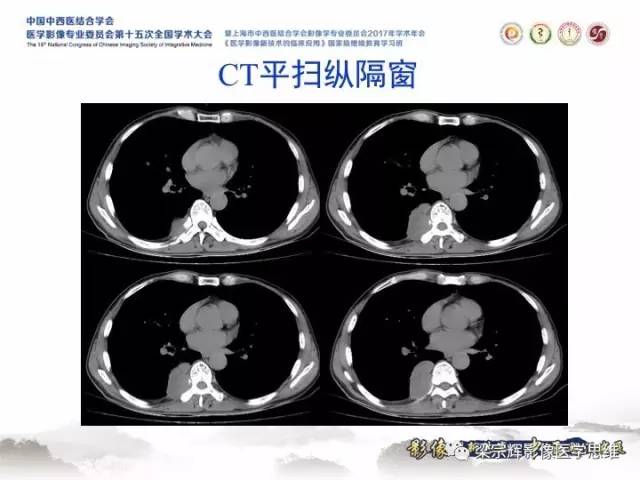 【病例】胸膜孤立性纤维瘤1例CT及MR影像表现