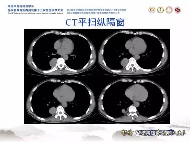 【病例】胸膜孤立性纤维瘤1例CT及MR影像表现