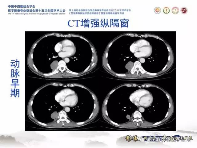 【病例】胸膜孤立性纤维瘤1例CT及MR影像表现
