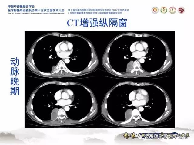 【病例】胸膜孤立性纤维瘤1例CT及MR影像表现