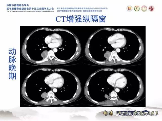 【病例】胸膜孤立性纤维瘤1例CT及MR影像表现