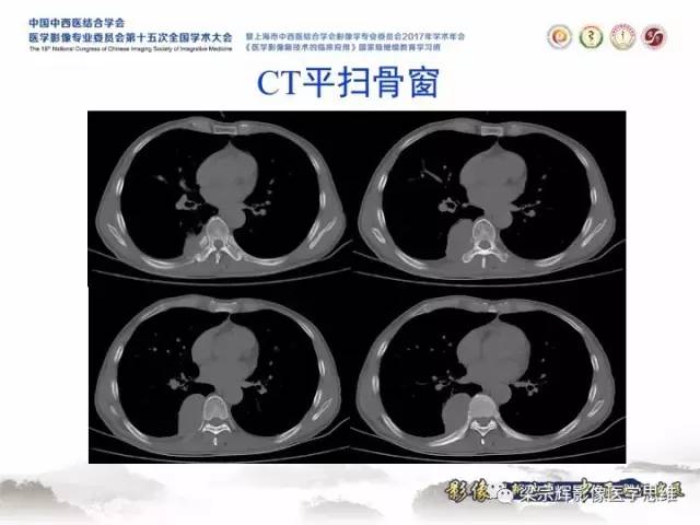 【病例】胸膜孤立性纤维瘤1例CT及MR影像表现