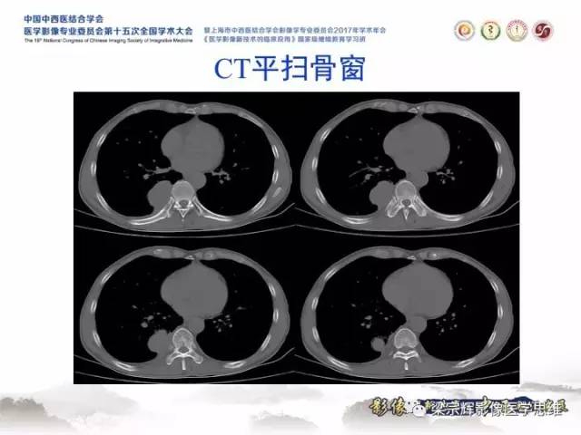 【病例】胸膜孤立性纤维瘤1例CT及MR影像表现