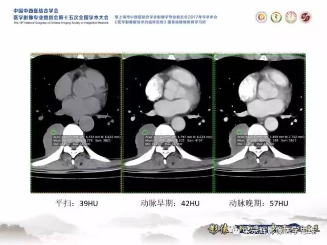 【病例】胸膜孤立性纤维瘤1例CT及MR影像表现
