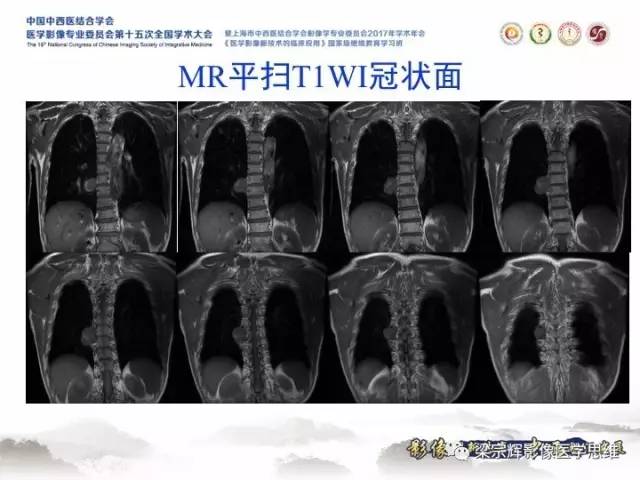 【病例】胸膜孤立性纤维瘤1例CT及MR影像表现