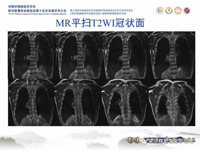 【病例】胸膜孤立性纤维瘤1例CT及MR影像表现