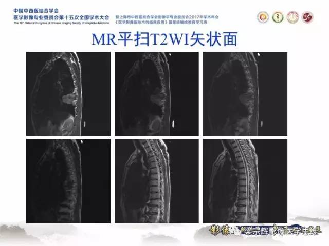【病例】胸膜孤立性纤维瘤1例CT及MR影像表现