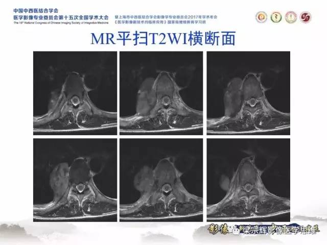 【病例】胸膜孤立性纤维瘤1例CT及MR影像表现