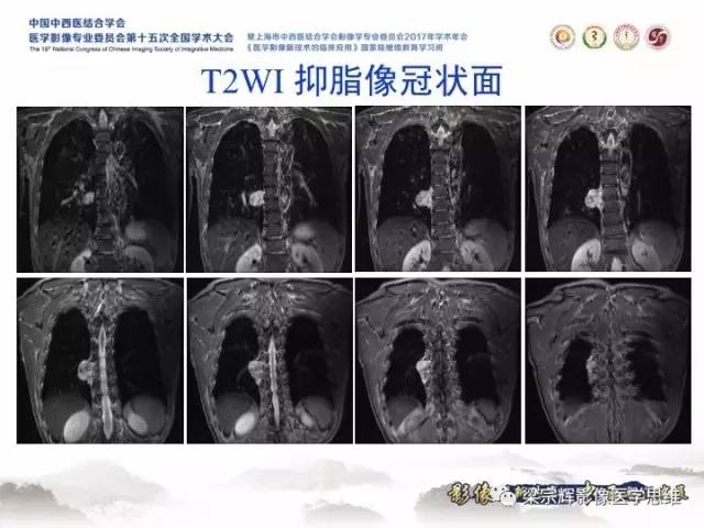 【病例】胸膜孤立性纤维瘤1例CT及MR影像表现