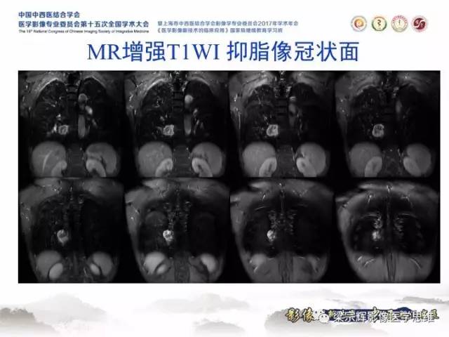 【病例】胸膜孤立性纤维瘤1例CT及MR影像表现