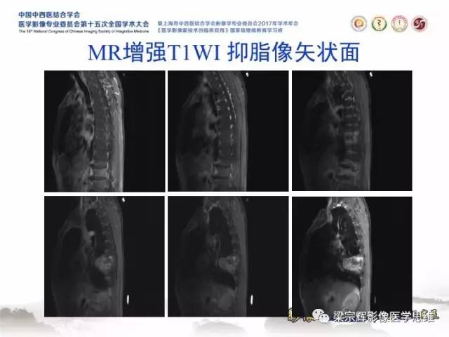【病例】胸膜孤立性纤维瘤1例CT及MR影像表现
