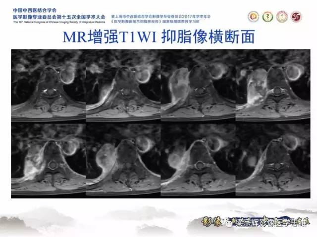 【病例】胸膜孤立性纤维瘤1例CT及MR影像表现