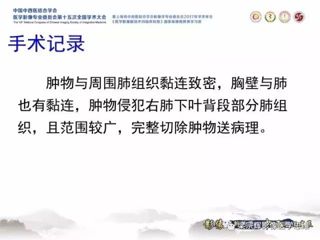 【病例】胸膜孤立性纤维瘤1例CT及MR影像表现