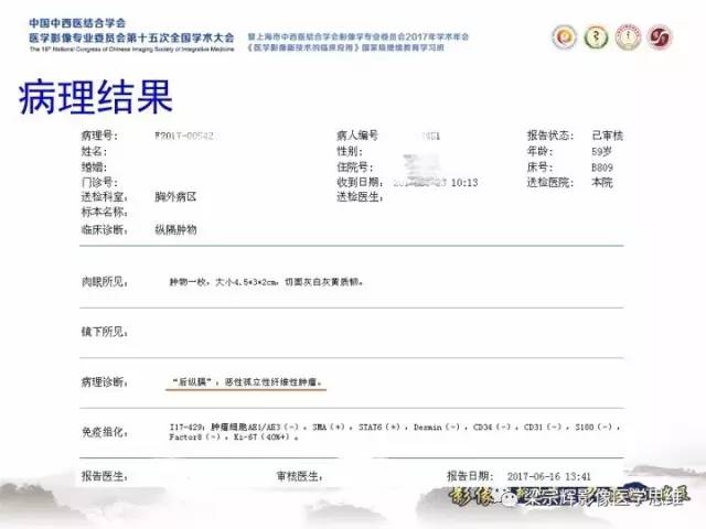【病例】胸膜孤立性纤维瘤1例CT及MR影像表现