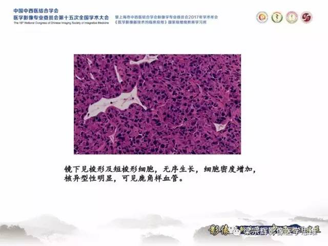 【病例】胸膜孤立性纤维瘤1例CT及MR影像表现