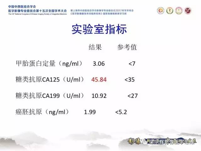 【病例】卵巢纤维肉瘤1例MR影像表现