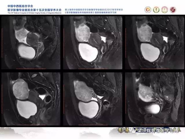 【病例】卵巢纤维肉瘤1例MR影像表现