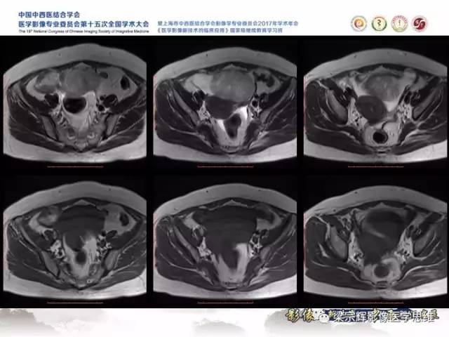 【病例】卵巢纤维肉瘤1例MR影像表现