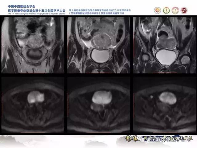 【病例】卵巢纤维肉瘤1例MR影像表现