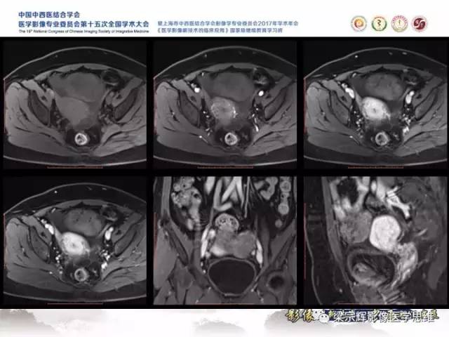 【病例】卵巢纤维肉瘤1例MR影像表现