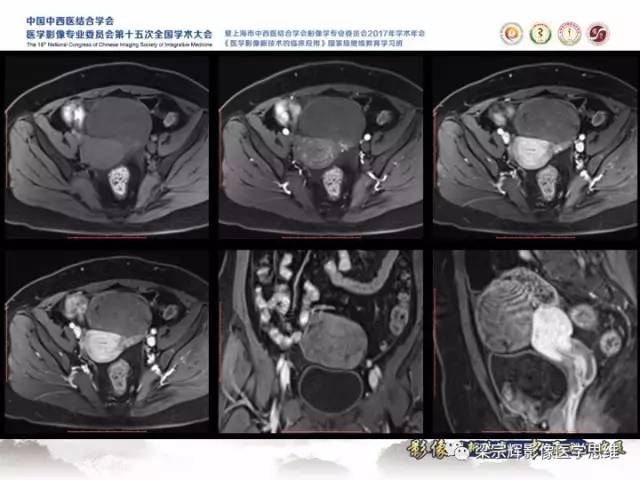 【病例】卵巢纤维肉瘤1例MR影像表现