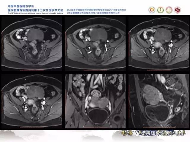 【病例】卵巢纤维肉瘤1例MR影像表现