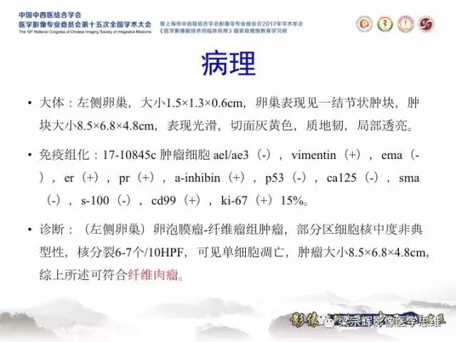 【病例】卵巢纤维肉瘤1例MR影像表现