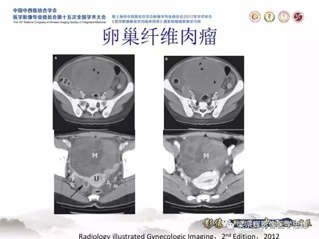 【病例】卵巢纤维肉瘤1例MR影像表现