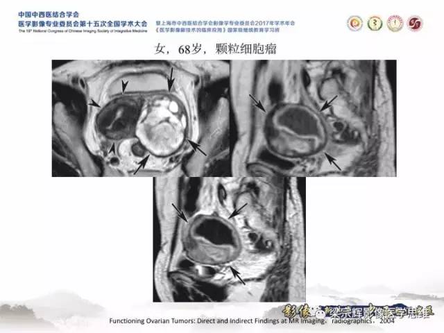 【病例】卵巢纤维肉瘤1例MR影像表现