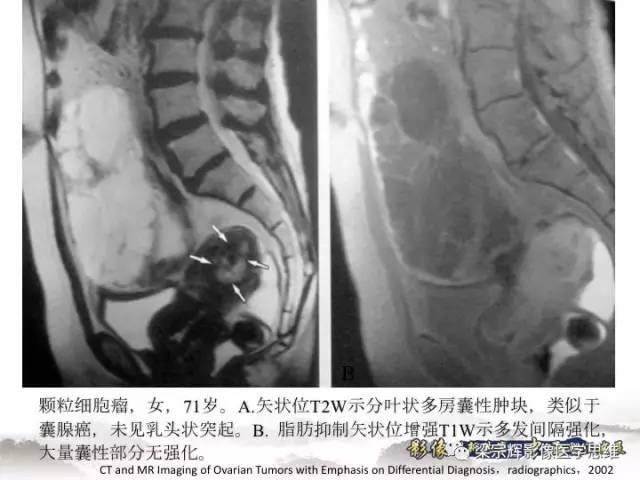【病例】卵巢纤维肉瘤1例MR影像表现
