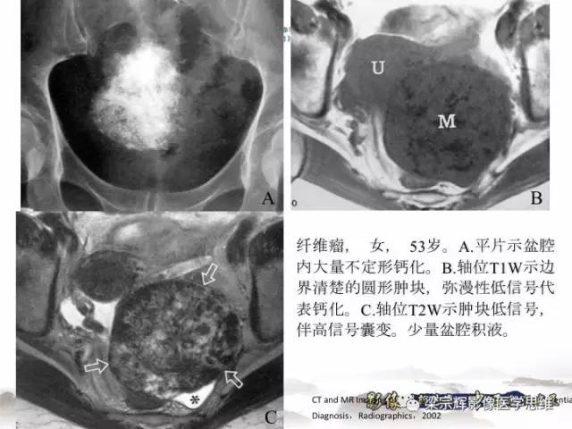 【病例】卵巢纤维肉瘤1例MR影像表现