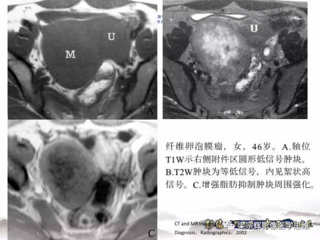 【病例】卵巢纤维肉瘤1例MR影像表现