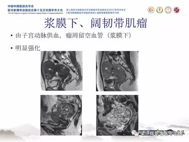 【病例】卵巢纤维肉瘤1例MR影像表现