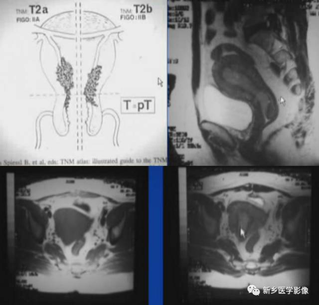 子宫恶性病变,应想到这5类疾病 子宫恶性病变,应想到这5类疾病
