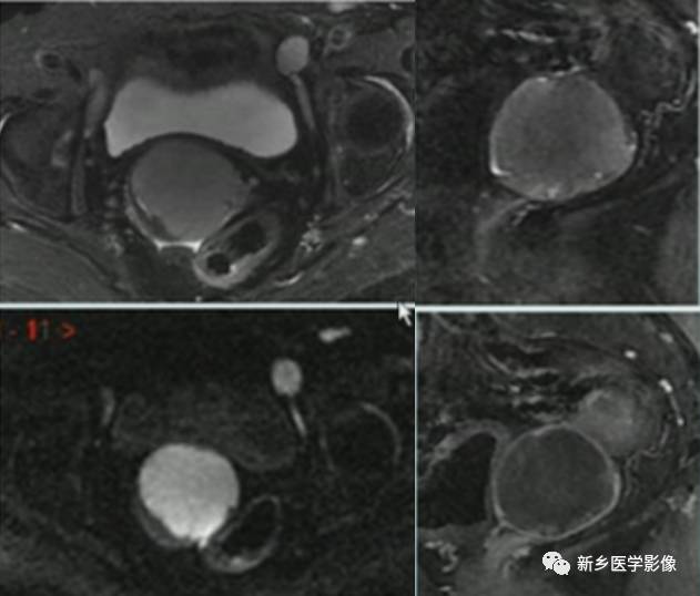 子宫恶性病变,应想到这5类疾病 子宫恶性病变,应想到这5类疾病