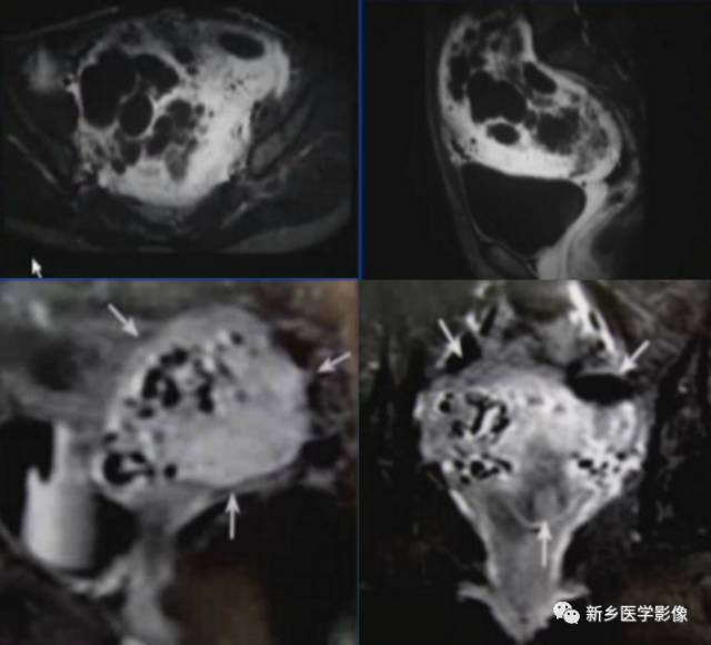 子宫恶性病变，应想到这5类疾病